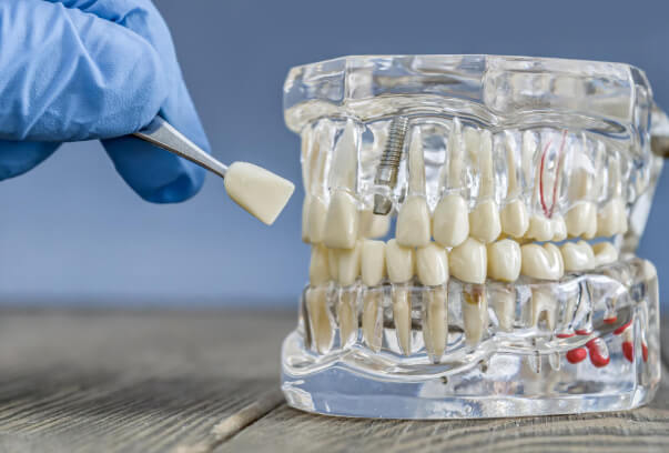 زراعة الاسنان في مسقط